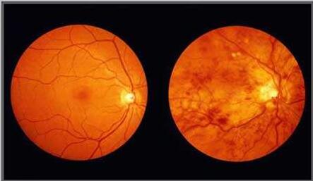 视网膜疾病.jpg