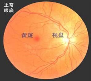 视网膜裂孔2.jpg