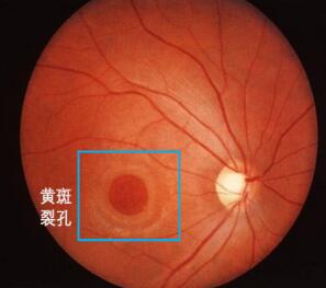 视网膜裂孔.jpg