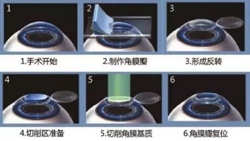 1522218109813504.jpg 近视准分子激光手术.jpg