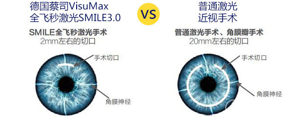 全飞秒激光近视矫正术