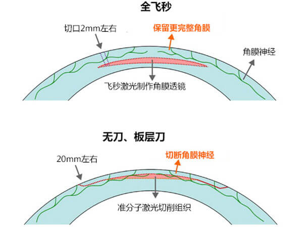 近视手术方式对比