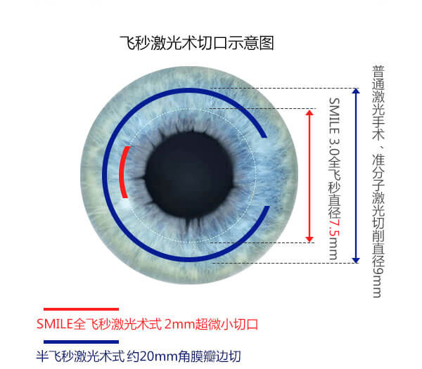 近视手术方式对比